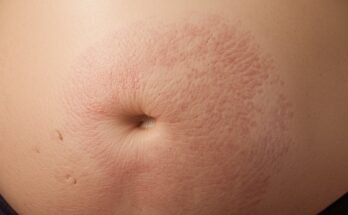 Stretch Marks